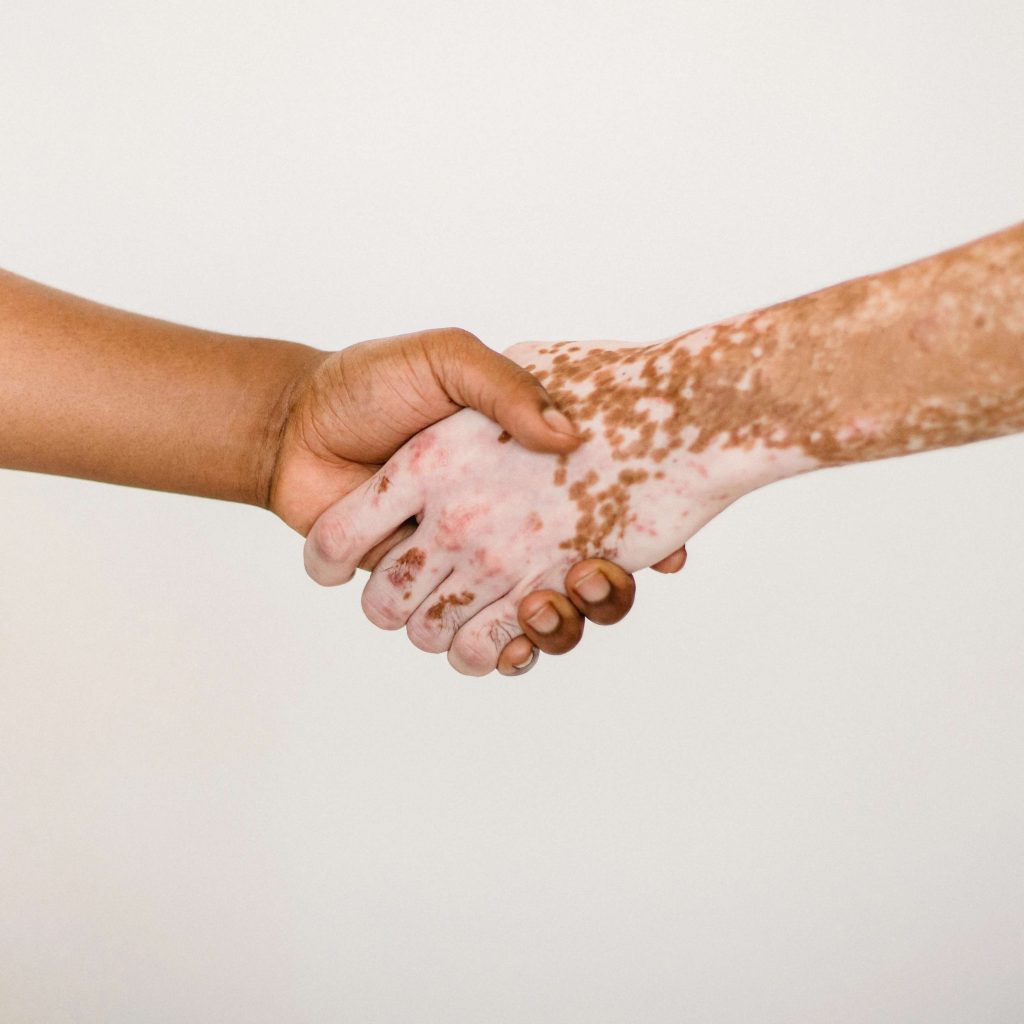 SANTÉ – Journée mondiale du vitiligo, que sait-on vraiment de cette maladie ?